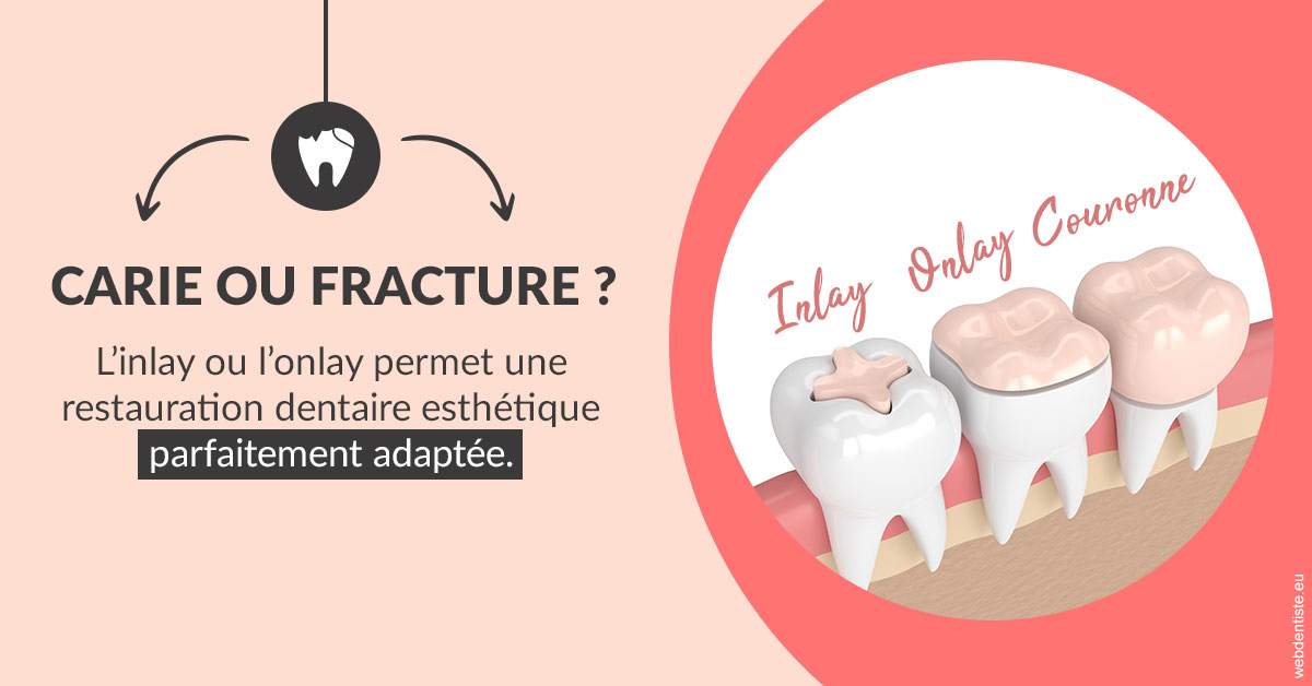 https://dr-medioni-philippe.chirurgiens-dentistes.fr/T2 2023 - Carie ou fracture 2