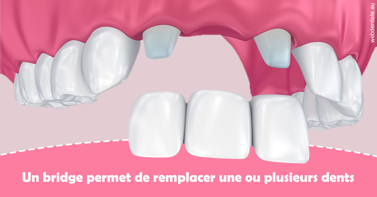 https://dr-medioni-philippe.chirurgiens-dentistes.fr/Bridge remplacer dents 2